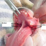 bilateral mandibular fx